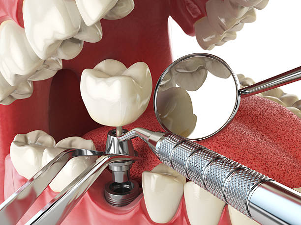 Best Emergency Cosmetic Dentistry (e.g., broken veneers) in USA
